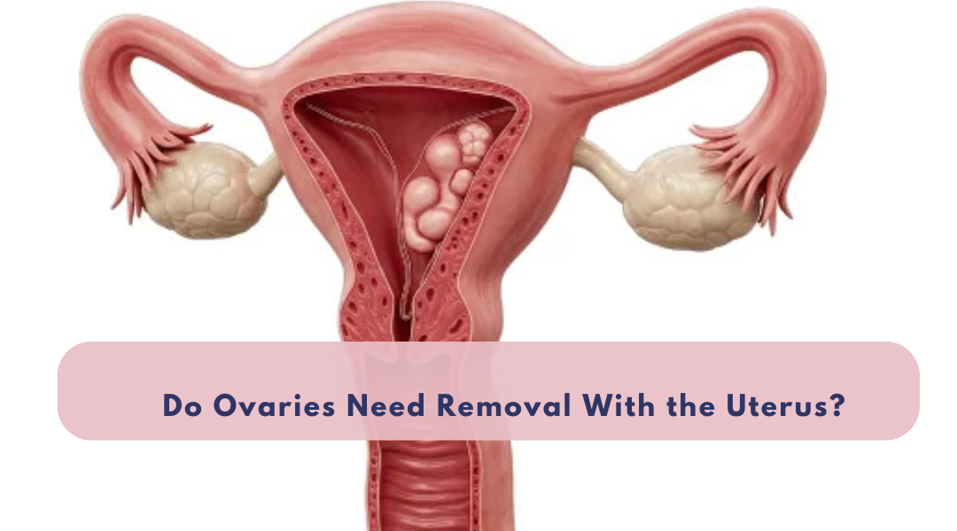 Do ovaries need removal with the uterus - Dr. Pallavi Chauhan, Gynecologist in Andheri East