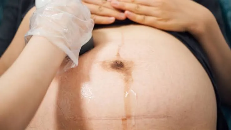 Previous Cesarean Section - drpallavichauhan Close-up of a pregnant belly during a medical exam with a gloved hand resting on the abdomen.